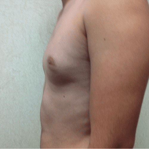 Gynecomastia 03 Before Photo