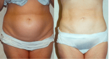 Before and After Liposuction
