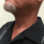 Facelift 18 After Thumbnail Photo