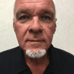 Facelift 18 Before Thumbnail Photo