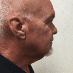 Facelift 18 Before Thumbnail Photo