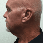 Facelift 18 Before Thumbnail Photo