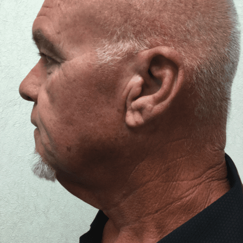 Facelift 18 Before Photo