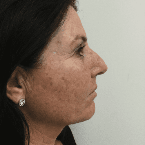 Infini Laser 01 Before Photo