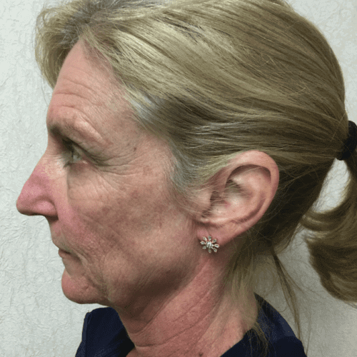 Infini Laser 02 Before Photo