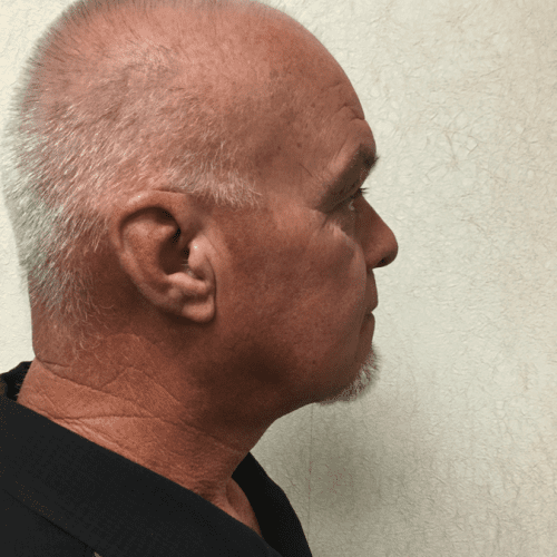 Facelift 18 After Photo