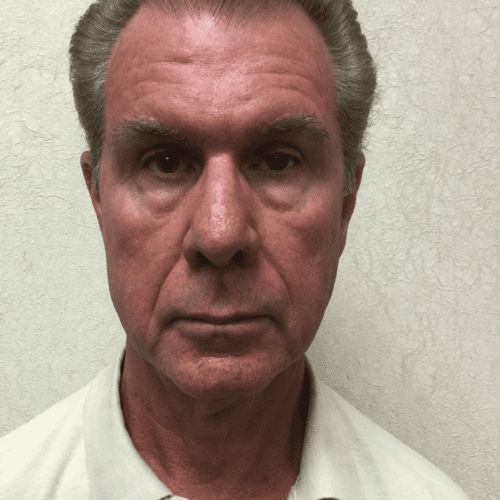 Male Cosmetic Surgery 10 After Photo