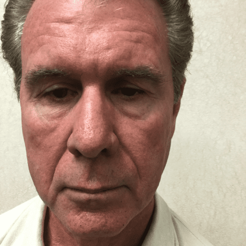 Male Cosmetic Surgery 10 Before Photo