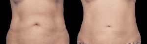 coolsculpting-before-and-after-photo