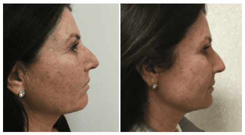 INFINI™ Before and After Photo