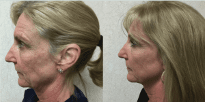 Before and After INFINI™ Laser