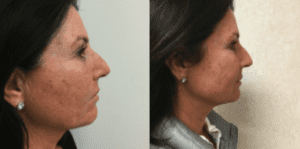 before-and-after-infini-laser