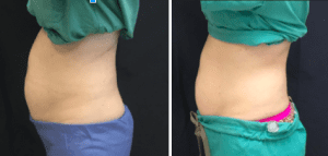 before-and-after-sculpsure