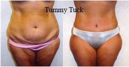 Tummy Tuck Results