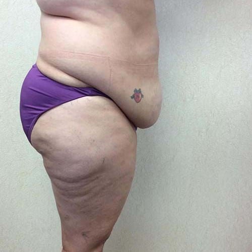 Liposuction 09 Before Photo