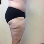 Liposuction 09 After Thumbnail Photo