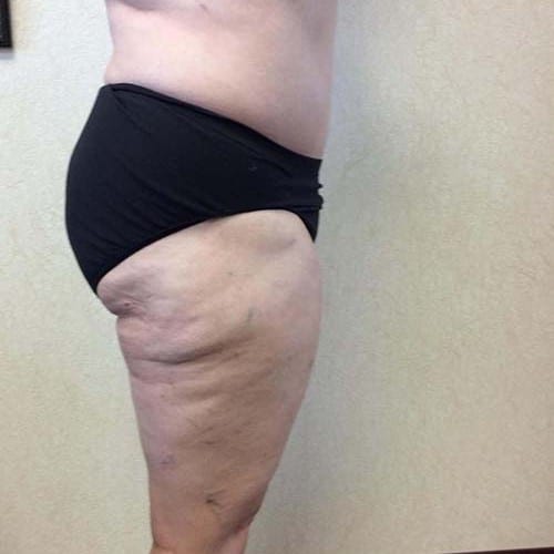 Liposuction 09 After Photo