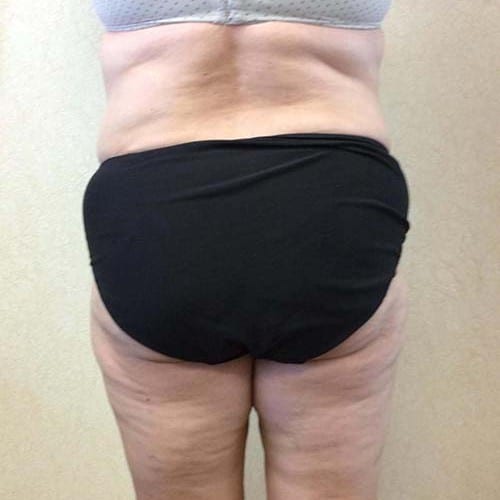 Liposuction 09 After Photo