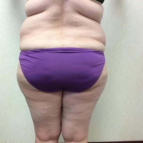 Liposuction 09 Before Photo