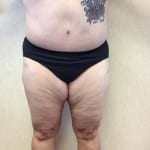 Liposuction 09 After Thumbnail Photo