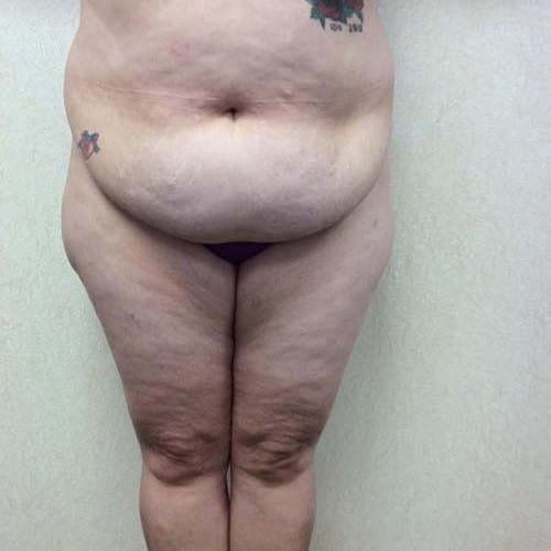 Liposuction 09 Before Photo