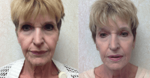 Laser therapy to peri ocular and peri oral areas by Dr. Wald