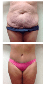 Wald Body Contouring Surgery Tummy Tuck