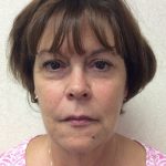 Facelift 19 Before Thumbnail Photo