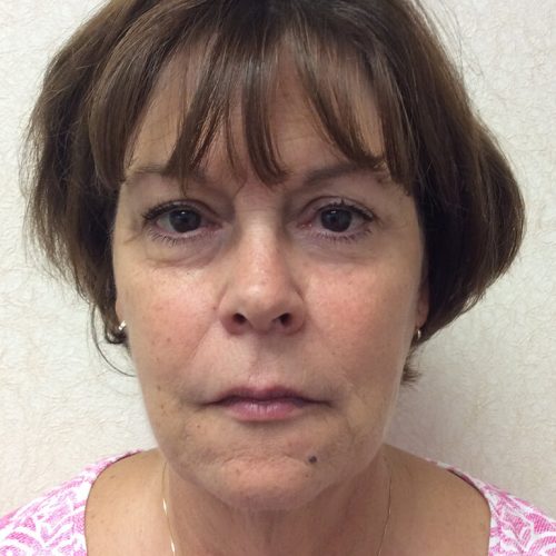 Facelift 19 Before Photo