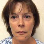 Facelift 19 After Thumbnail Photo