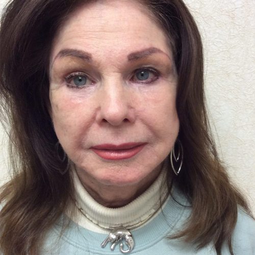 Facelift 20 After Photo