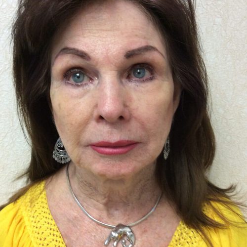 Facelift 20 Before Photo