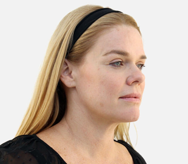 before instalift patient