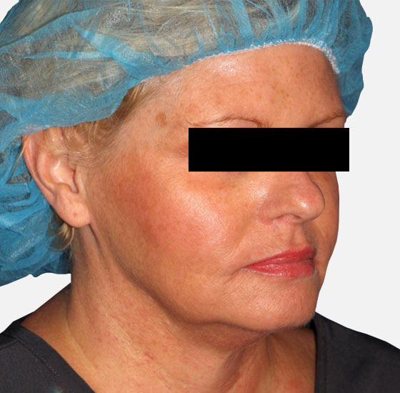 before instalift woman