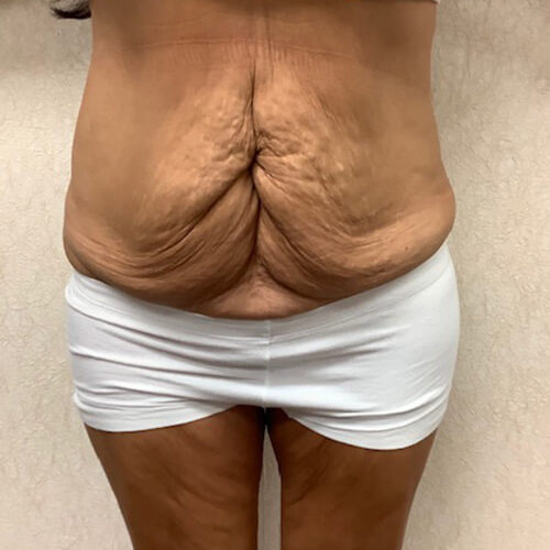 Abdominoplasty 09 Before Photo