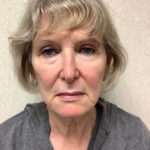 Facelift 21 Before Thumbnail Photo