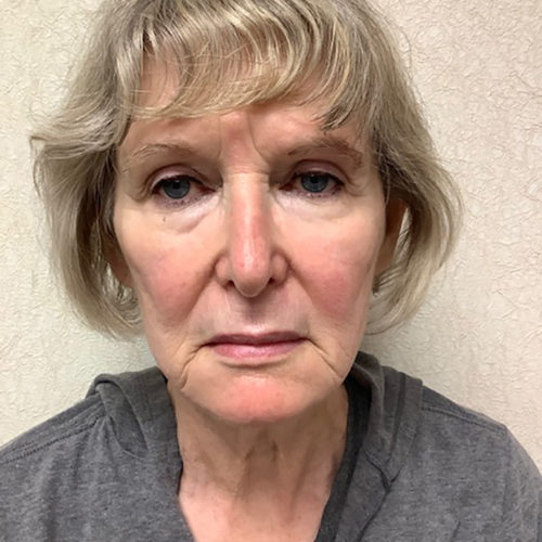 Facelift 21 Before Photo