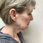 Facelift 21 Before Thumbnail Photo