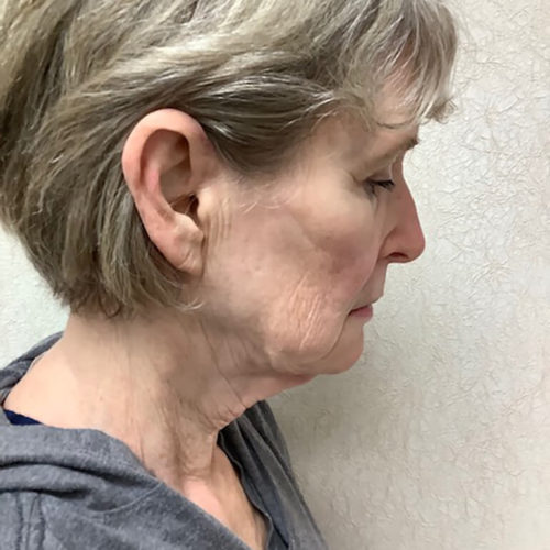 Facelift 21 Before Photo