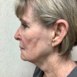 Facelift 21 Before Thumbnail Photo