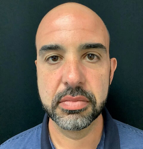 Liposuction 16 After Photo