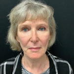 Facelift 21 After Thumbnail Photo