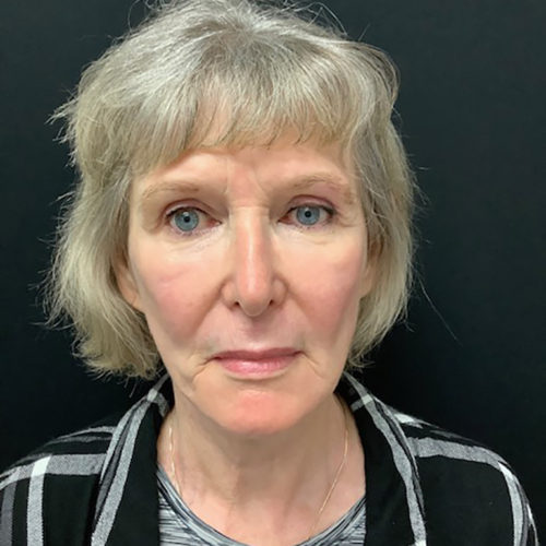 Facelift 21 After Photo