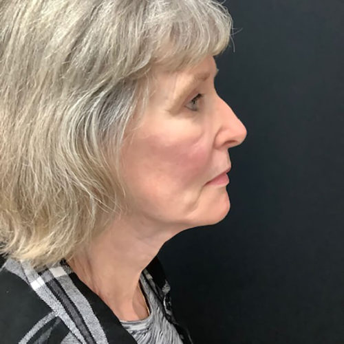 Facelift 21 After Photo