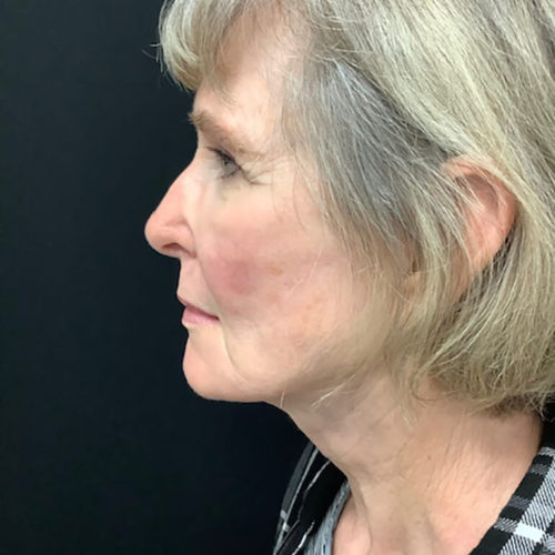 Facelift 21 After Photo