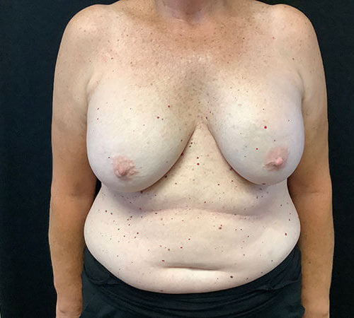 Breast Implant Removal 02 Before Photo