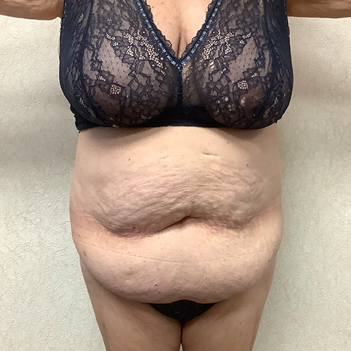 Abdominoplasty 10 Before Photo