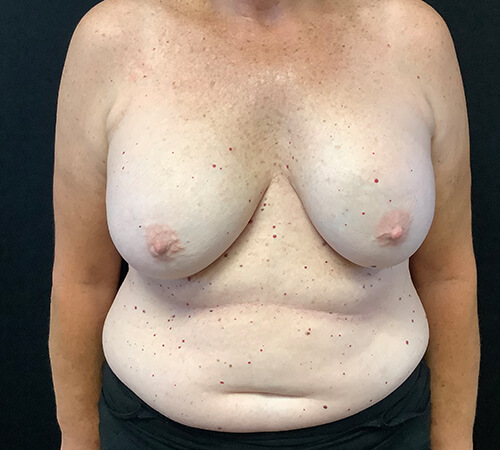 Breast Implant Removal 04 Before Photo