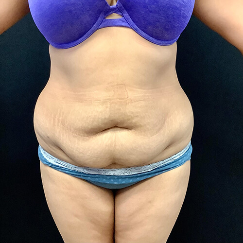 Abdominoplasty 13 Before Photo