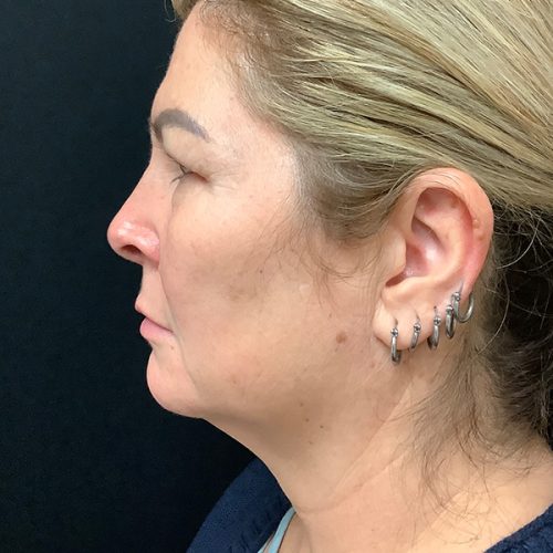 Neck Liposuction Patient Before Photo